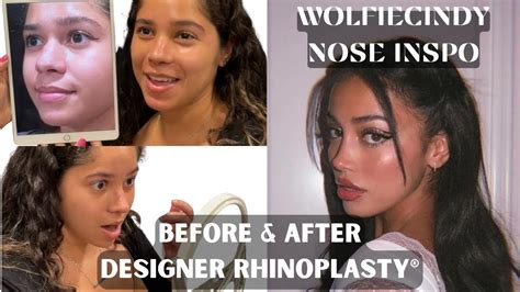 WOLFIE CINDY INSPO NOSE Before After Nose Job YouTube