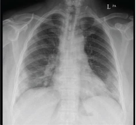 Chest X Rays Of Two Patients A And B A Focal Areas Of Ground Glass
