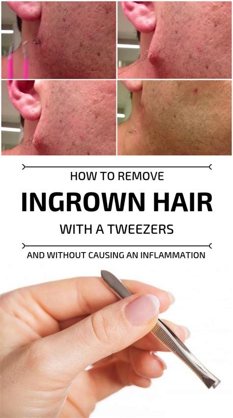 How To Remove Ingrown Hair With A Tweezers And Without Causing An Inflammation My Beauty Tips