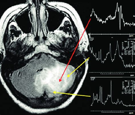 Acute Infarct In The Left Cerebellum Upper Right Panel Infarct Core