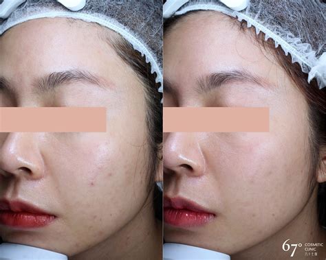 Mesotherapy 67 Degrees Cosmetic Clinic