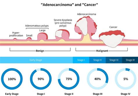 Different Stages Of Colorectal [image] Eurekalert Science News Releases