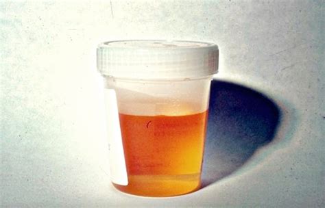 Orange Urine Causes Symptoms Diagnosistreatment Hubpages