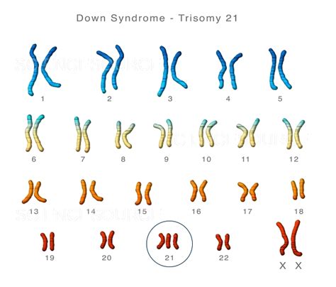 Photograph Down Syndrome Karyotype Science Source Images
