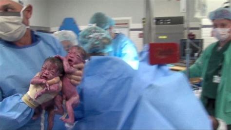 hospital welcomes second set of rare mono mono twins abc news