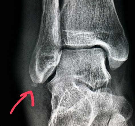 Ankle Xray Shows A Fracture Of The Fibula Outer Part Of Ankle