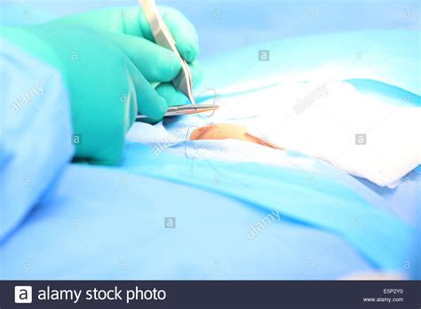 Epigastric Hernia Hi Res Stock Photography And Images Alamy