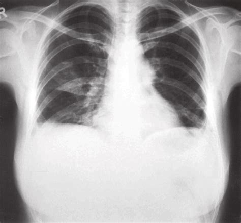 Standard Postero Anterior Chest Radiograph Of Patient After Lung