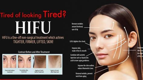 Hifu Nonsurgical Face Lift