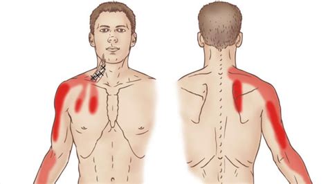 TRIGGER POINT CERVICALE Trigger Point Sternocleidomastoideo Trigger