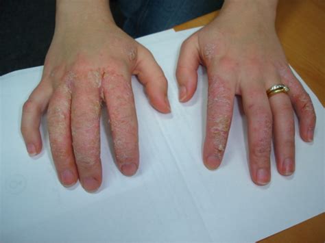 Contact Dermatitis Wrist
