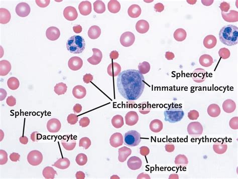 Immature Granulocytes Causes Absolute And Normal Range