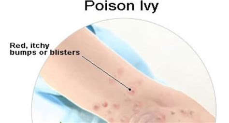 How To Get Rid Of Poison Ivy Rash