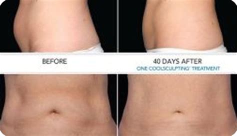 Harvard Trained Doctors Where Can I Get Coolsculpting In Natick