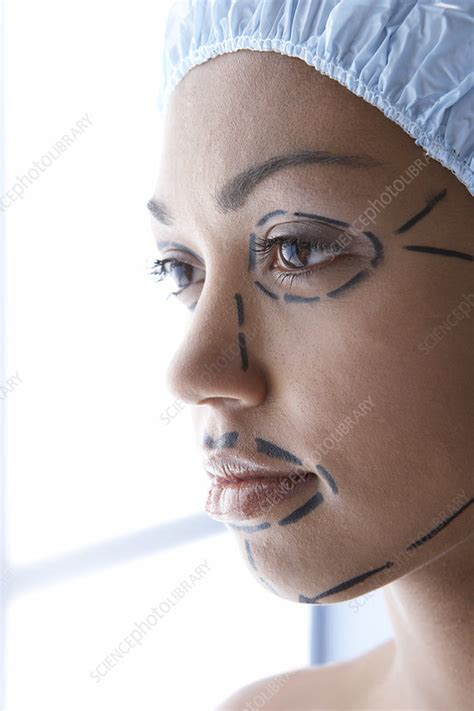Facelift Surgery Markings Stock Image F0025149 Science Photo Library
