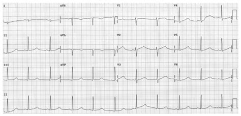 Routine Ecg Showing Sinus Rhythm With Markedly Prolonged Qt 528 Ms