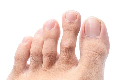 Toe Straightening Toe Lengthening Toe Shortening Moore Foot And