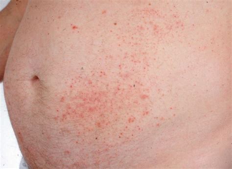 Dermatitis Herpetiformis Diagnosis With Skin Biopsy