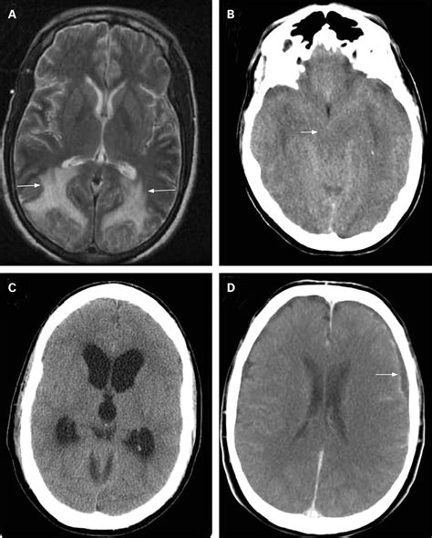 Community Acquired Bacterial Meningitis In Adults Practical Neurology