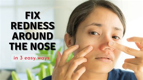 How To Fix Redness Around Nose In 3 Easy Ways Youtube