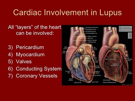 Lupus And Cardiovascular Disease