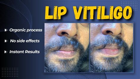 Vitiligo Lips Treatment Organic Process Machu Clinic Youtube