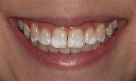 White Streaks On Teeth After Whitening Teethwalls