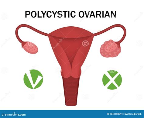 Polycystic Ovary Syndrome Or Pcos Cartoon Vector 203463341