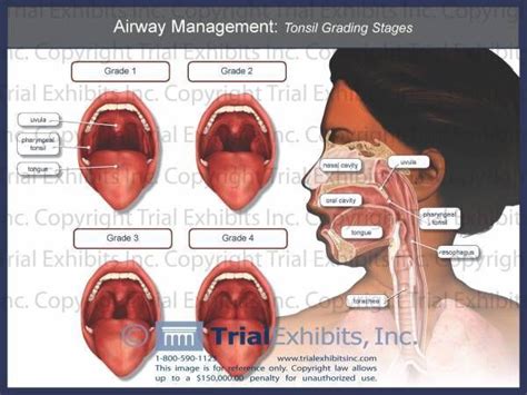 110003 Airway Management Tonsil Grading Stages Airway Management