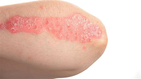 Psoriasis Vs Eczema Know The Difference