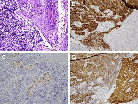 Hpv Positive Oropharyngeal Carcinoma Shows Both Small Cell And Squamous