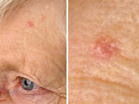 Basaalcelcarcinoom Bcc Basal Cell Carcinoma Ca Basocellulare
