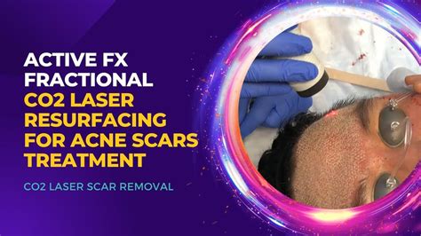 Active Fx Fractional Co2 Laser Resurfacing For Acne Scars Treatment
