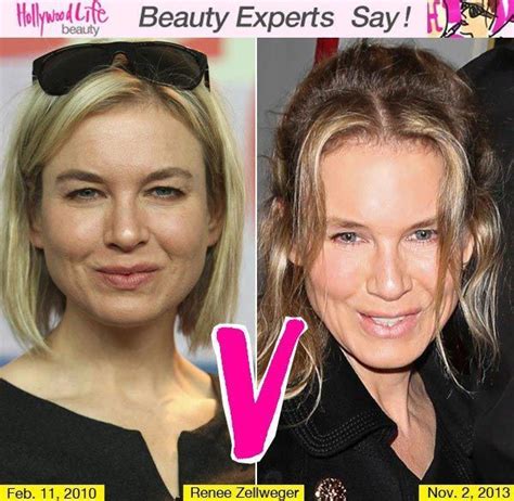 Renee Zellweger Plastic Surgery Before And After Celebrity Plastic