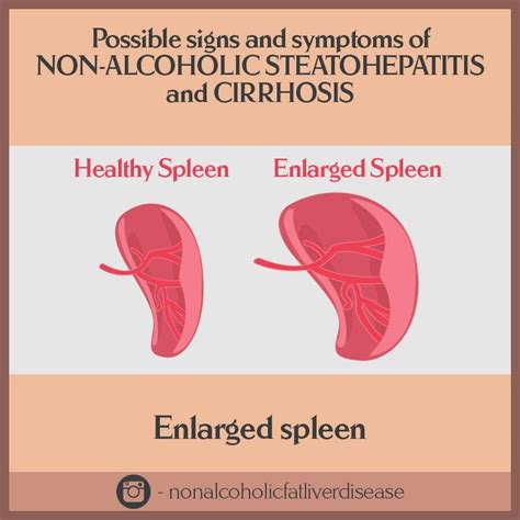 Enlarged Spleen Is One Sign Of Having Non Alcoholic Steatohepatitis And