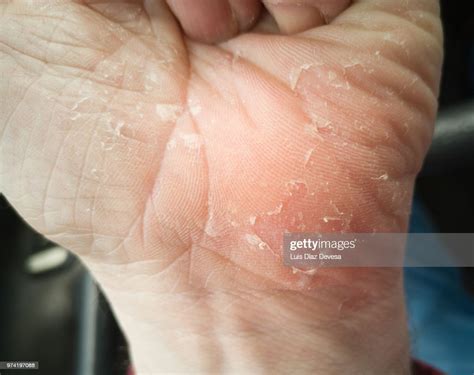 Man With Cracked Skin Photo Getty Images