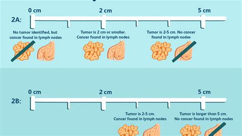 Brain Tumor Size Chart Cm Best Picture Of Chart Anyimageorg
