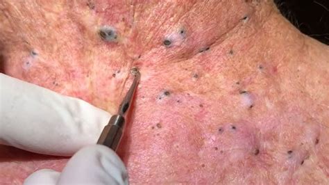 Awesome Extraction Blackheads Part Youtube