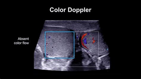 Ultrasound In Scrotal Doppler Testicular And Scrotal Doppler Ultrasound