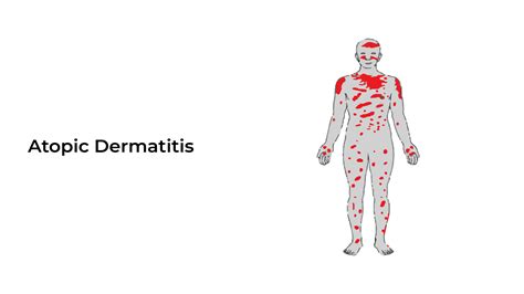 Atopic Dermatitis Types Causes And Treatment ~ Healthcare City