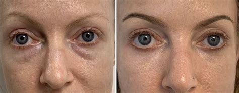 How To Reduce Bags Under Eyes