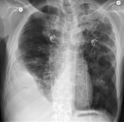 Pleural Effusions Radiology Key