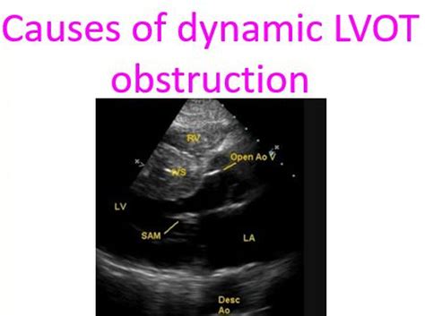 Causes Of Dynamic Lvot Obstruction All About Cardiovascular System