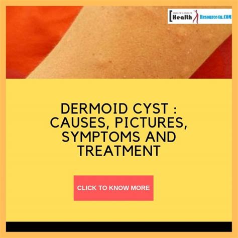 Dermoid Cyst Causes Pictures Symptoms And Treatment