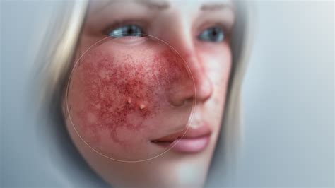 Rosacea Types Causes And Treatment Scientific Animations