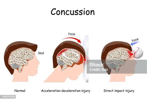 Concussion In Sport Mild Traumatic Brain Injury Stock Illustration