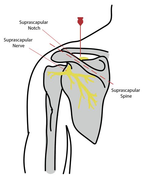 Figure Diagram Showing Suprascapular Nerve Block Contributed By Rian