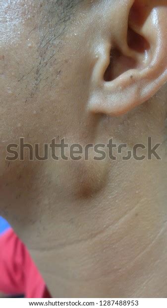 Preauricular Swelling Differential Diagnosis Parotid Swelling Stock