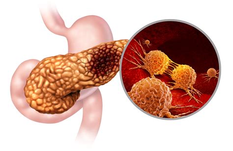 câncer de pâncreas o que é quais as causas principais sintomas e My
