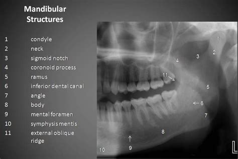Mandibular Structures Dental Dental Implants Cost Dental Anatomy